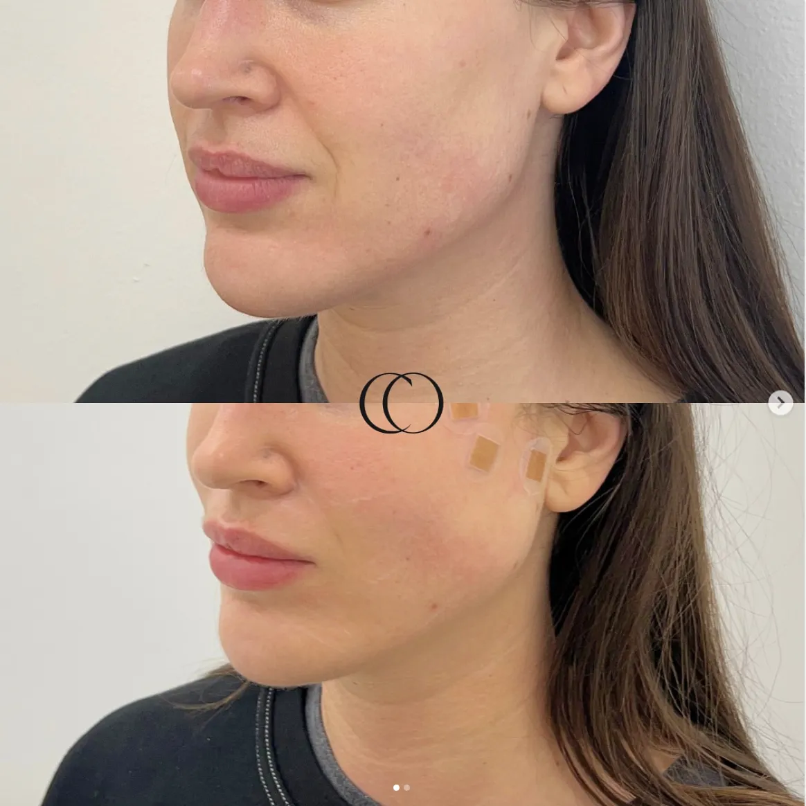 Before and after — Jawline definition
