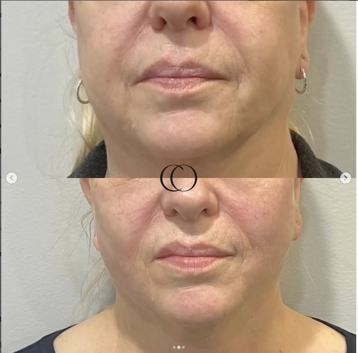 Before and after — Chin & lower face restoration
