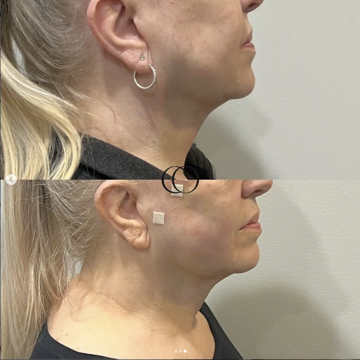 Before and after — Neck & jawline profile