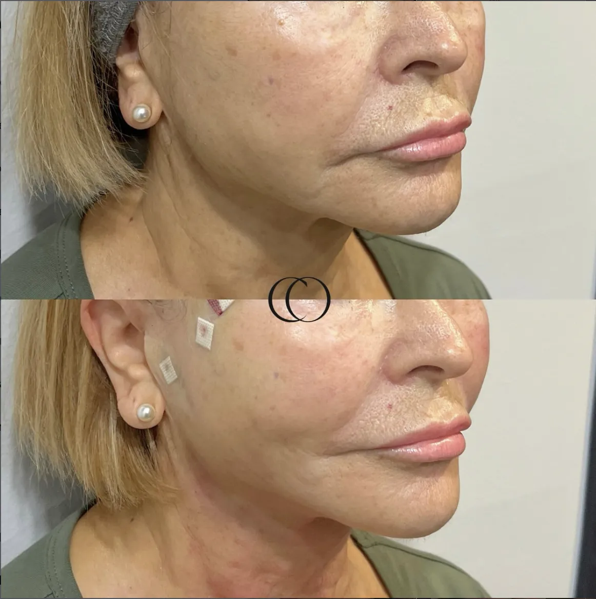 Before and after — Lower face rejuvenation