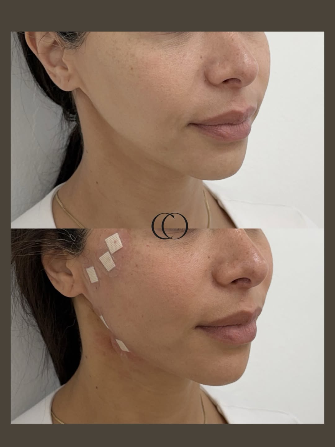Before and after — Cheek & jawline contouring