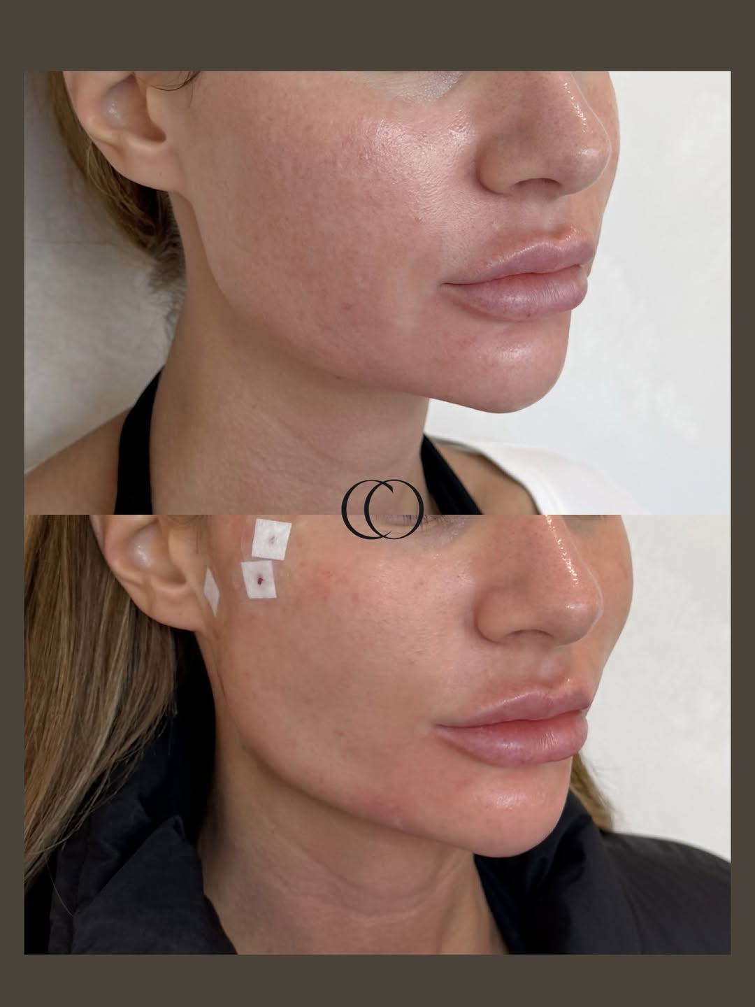 Before and after — Lip enhancement & perioral rejuvenation