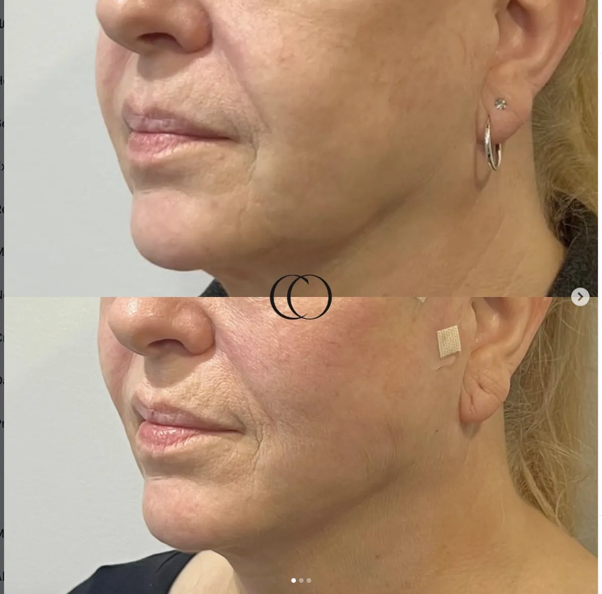 Before and after — Jawline & chin contouring