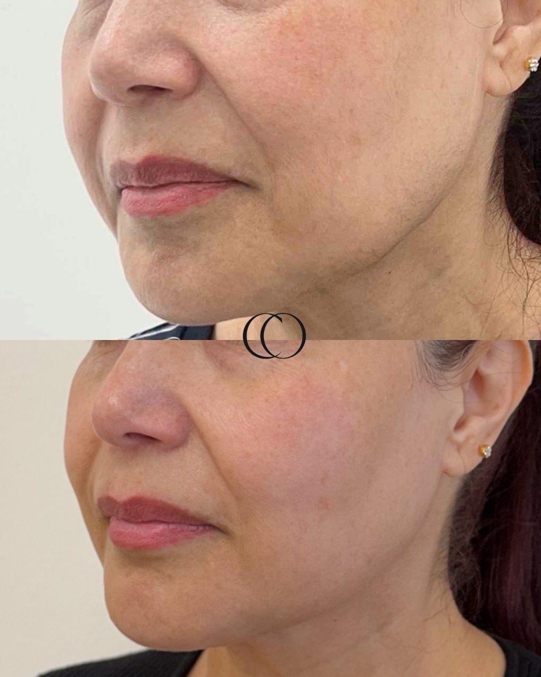 Before and after — Lower face & jawline refinement